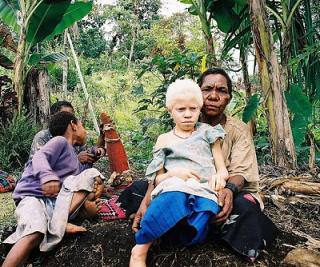 An albino girl from Papua New Guinea